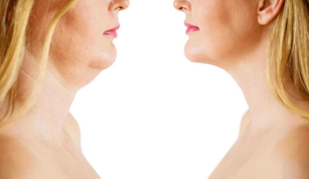 Double Chin treatment Watford before and after results