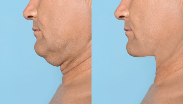 Which Non-Surgical Treatments Work Best for Jowls and Loose Skin Watford?