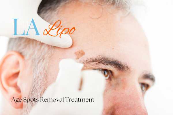 What Are the Most Effective Treatments for Age Spots Watford?