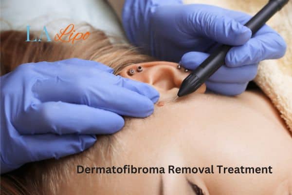 Dermatofibroma Removal Treatment Watford