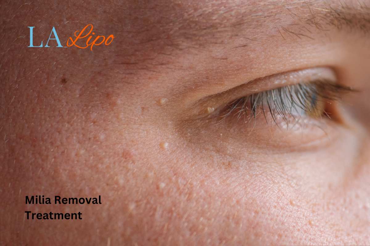 Cryopen Milia Removal: Is It the Easiest and Safest Option Watford?