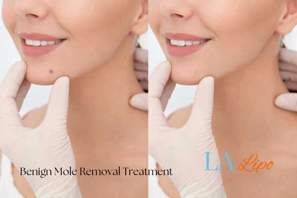 Before-and-after results following benign mole-removal treatment Watford