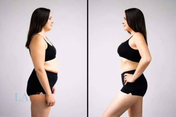 image of woman before and after results of LA-EMS Body Sculpting Watford to help treat Diastasis recti