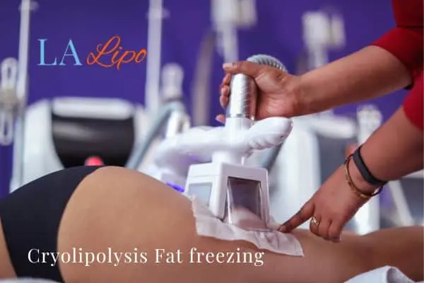 women getting fat freezing Watford
