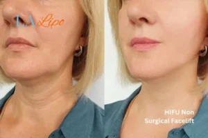 hi-fu for wrinkles Watford before and after results