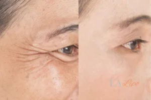 Before and after results of woman - HI-fu wrinkles reduction treatment Watford