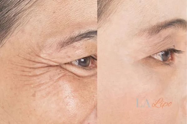 Before and after results of woman - HI-fu wrinkles reduction treatment Watford
