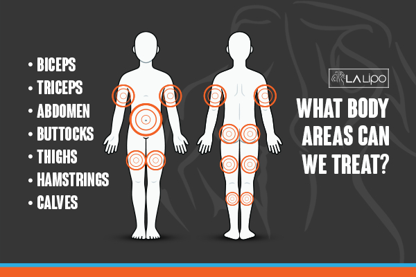 Graphic to show areas you can have LA-EMS Body Sculpting Watford treatment.