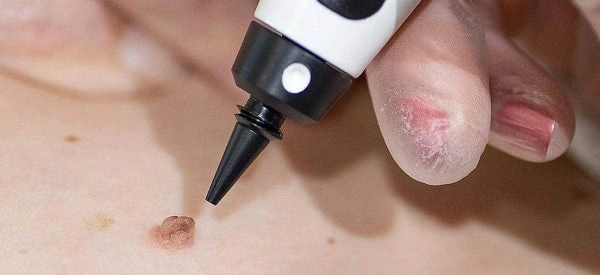 skin tag removal using cryopen Watford