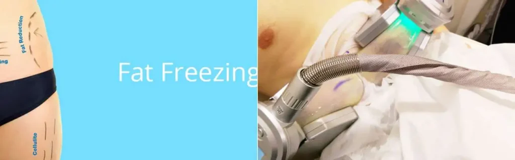 Fat freezing Watford on multiple areas of the body