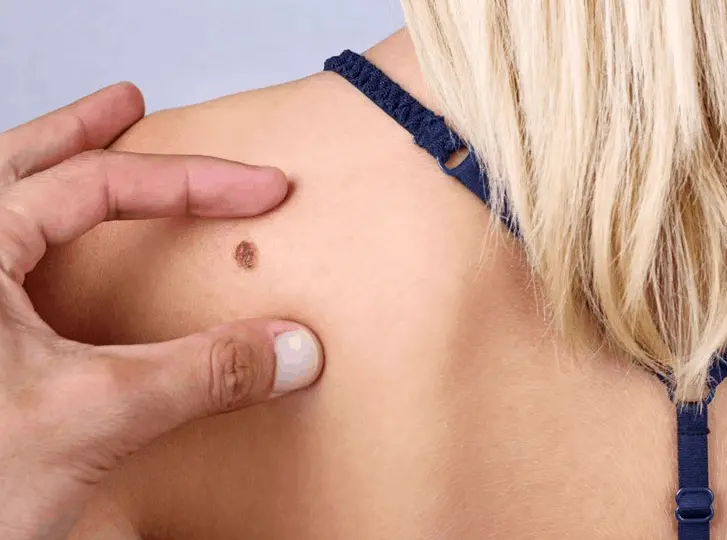 woman having mole removal Watford consultation before treatment.