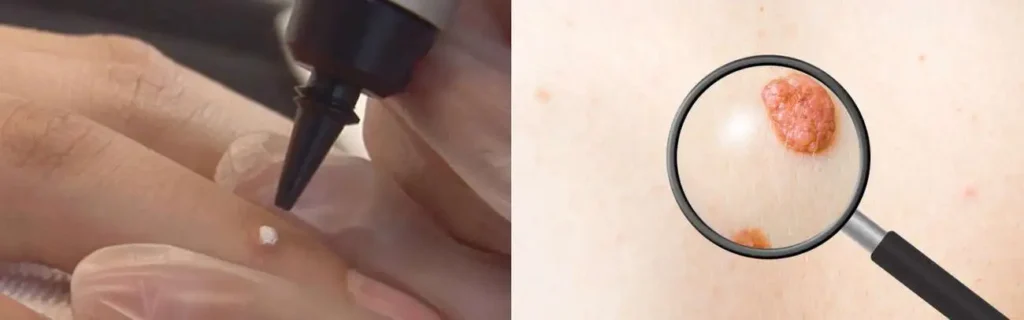 Cryopen for mole removal Watford - speak to our team today!