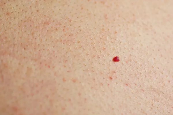 close up of a cherry angioma Watford