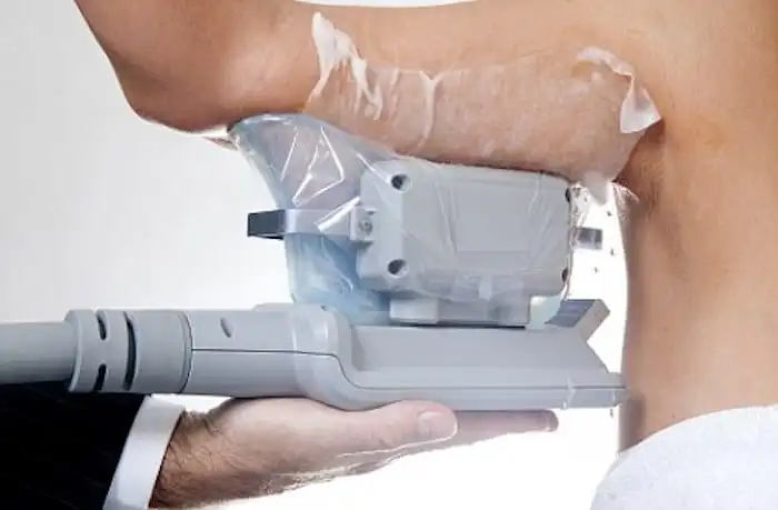 Picture of fat freezing Watford on the upper arms.