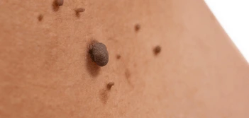 image of a skin tag Watford