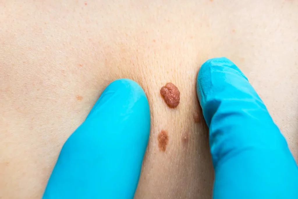 Consultant examining a skin tag Watford
