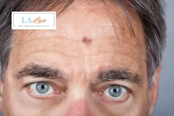 Solar Lentigo Removal Watford image of man with mark on his forehead