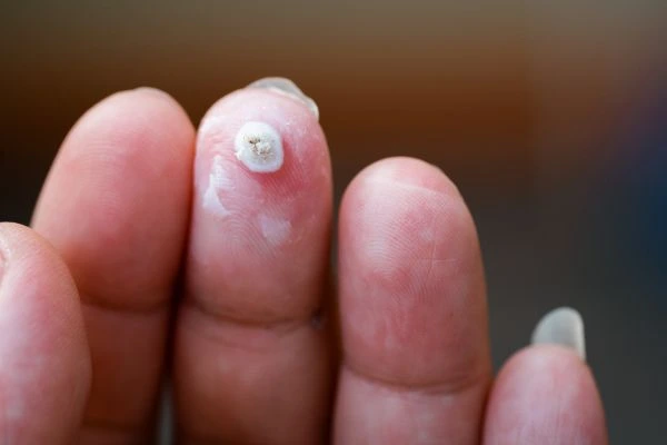 wart on person finger - cryotherapy to treat from LA LIPO Watford