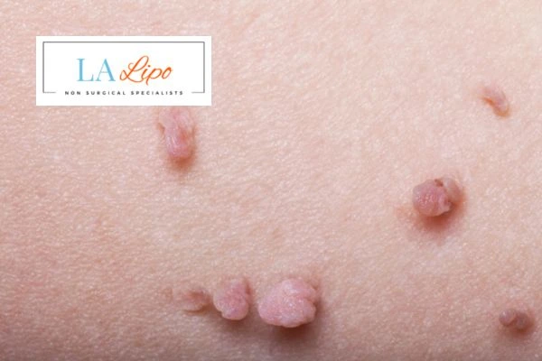 Does cryopen skin tag removal Watford hurt? Find out now call our team today!