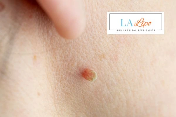 Book skin tag removal Watford today speak to our team now!
