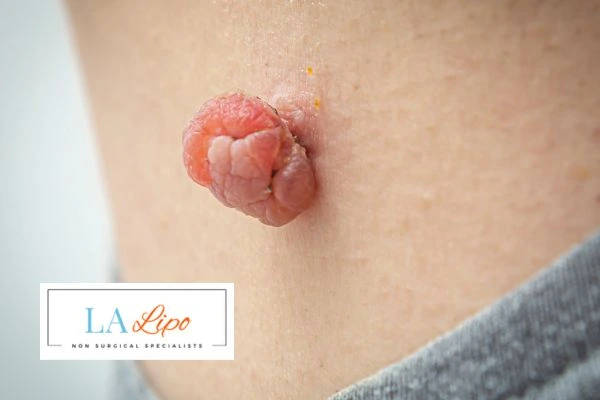 Interested in skin tag removal Watford? Concerned about the pain? Find out more today!