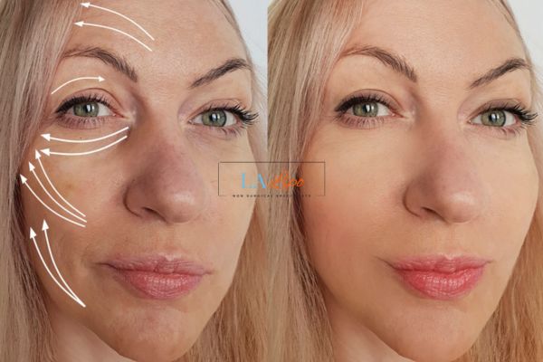 Morpheus 8 results Watford face lift.