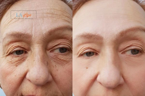 The powerful benefits of Morpheus8 Treatment Watford - Call Our team today!