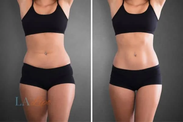 before and after results of non-surgical treatment to help a woman's body image and mental health Watford