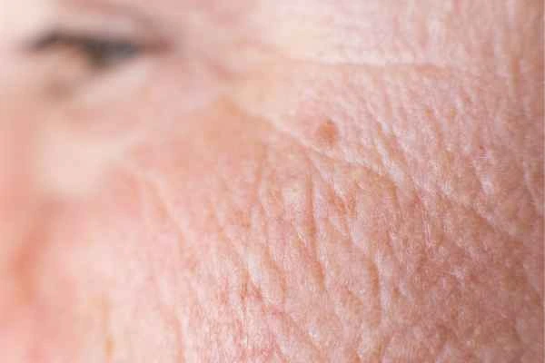 close up picture of a woman's face showing an age spot Watford
