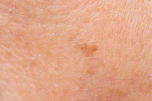 close up picture of age spots Watford