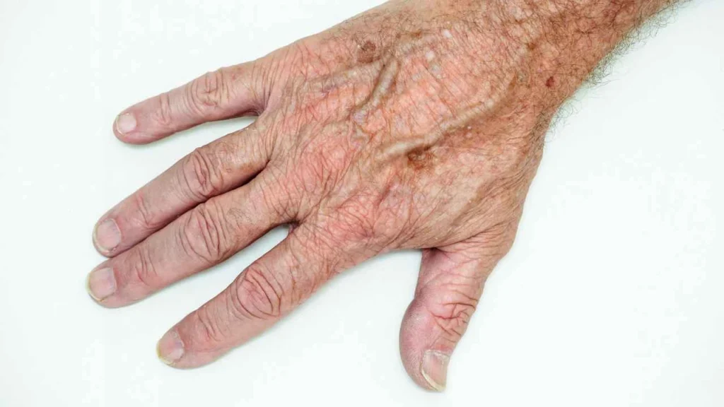 Male hand showing age spot Watford