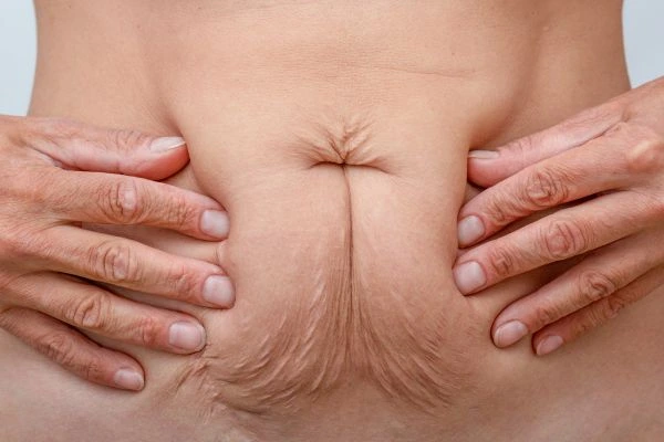 Image of a woman's stomach with loose skin - example of skin tightening Watford options
