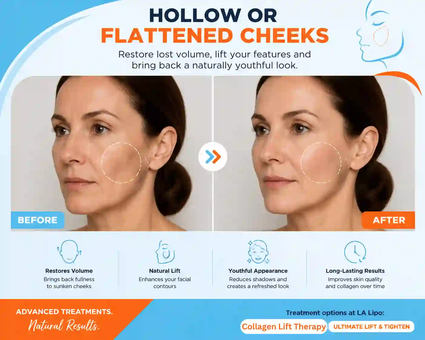 Sign #4: Hollow or Flattened Cheeks Watford
